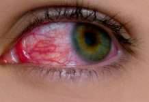 Eye Flu in Delhi: बचाव, लक्षण, इलाज और घरेलू नुस्खे Eye-Flu-in-Delhi-Eye-Flu-Eye-Flu-in-Delhi-in-Hindi-inhindiwise